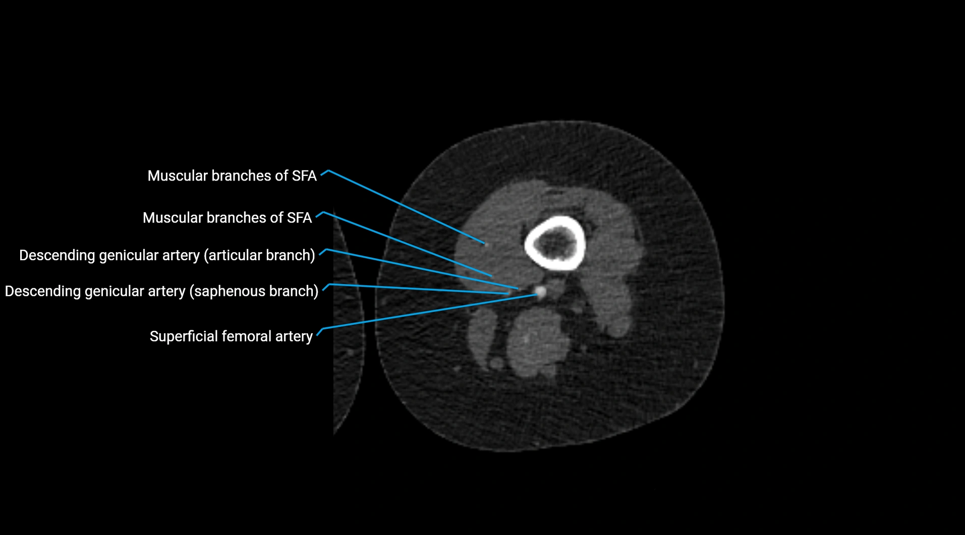 CTA lower limb cross sectional anatomy labelled image _152.webp